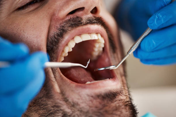 Best Emergency Dental Care for Broken or Chipped Teeth in Youngstown, NY