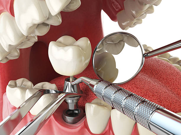 Best Urgent Care for Lost Fillings or Crowns in Youngstown, NY